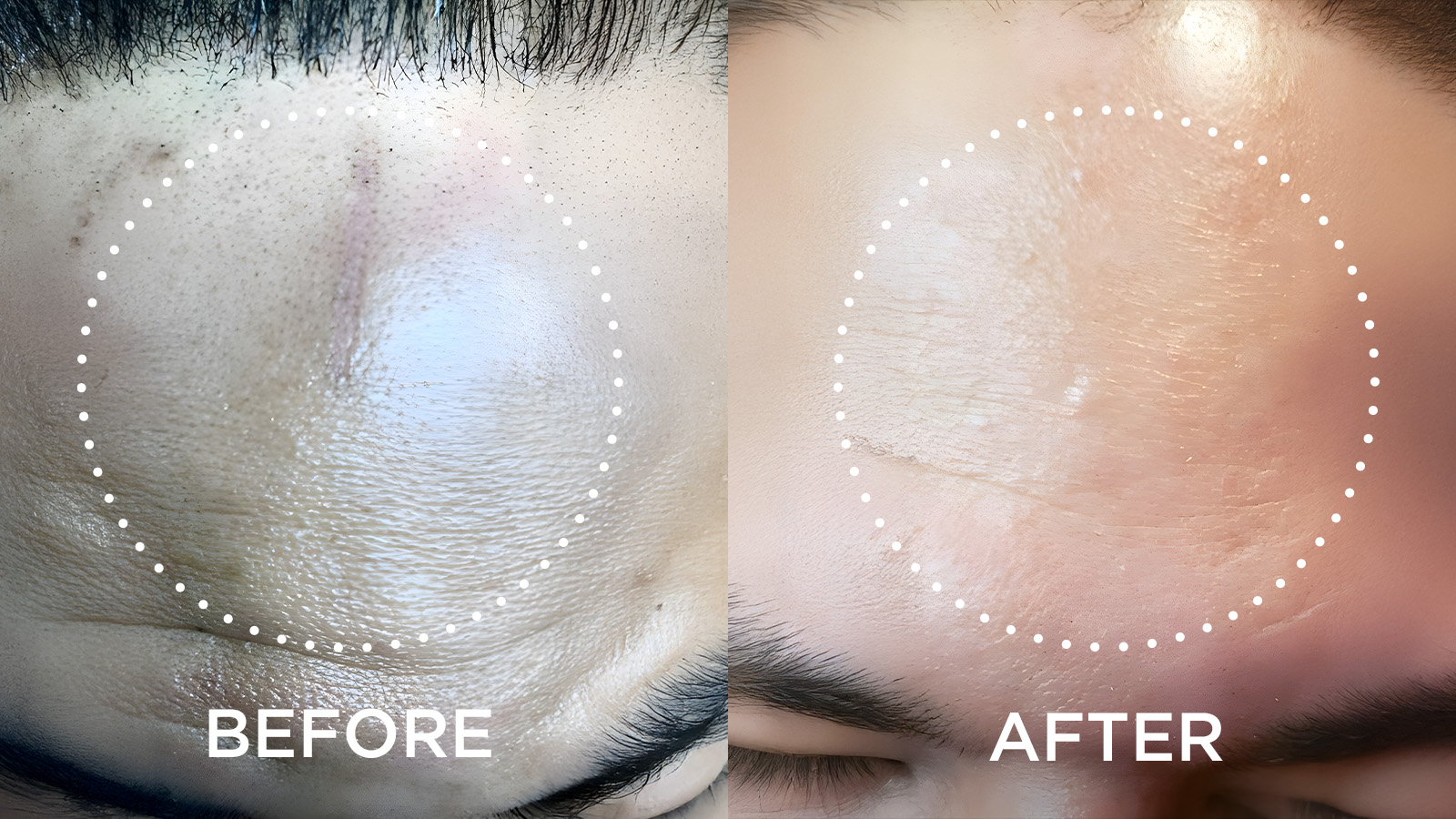 Side by side of man's forehead before & after